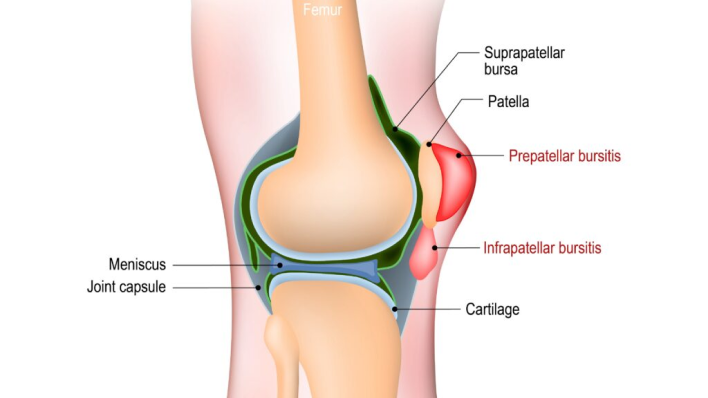 Kneecap Bursitis