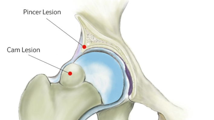 Femoroacetabular Impingement (FAI)
