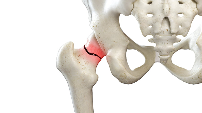 hip fracture