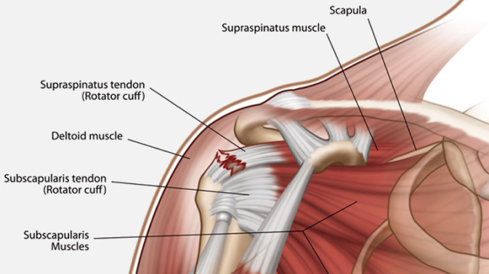 Rotator Cuff Tear