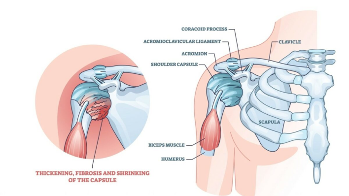 Frozen Shoulder