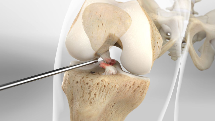 acl reconstruction surgery Dubai