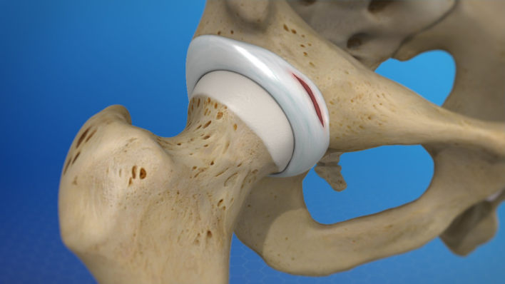 hip ligament injury