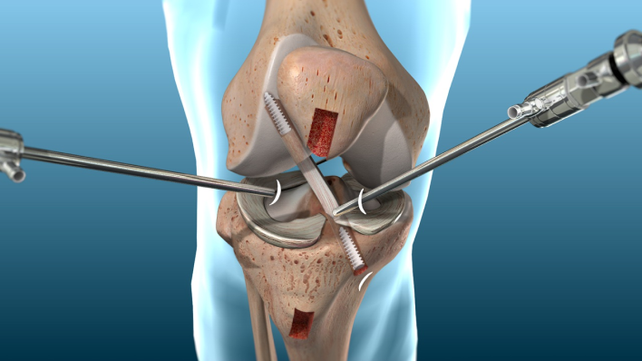 ACL tears