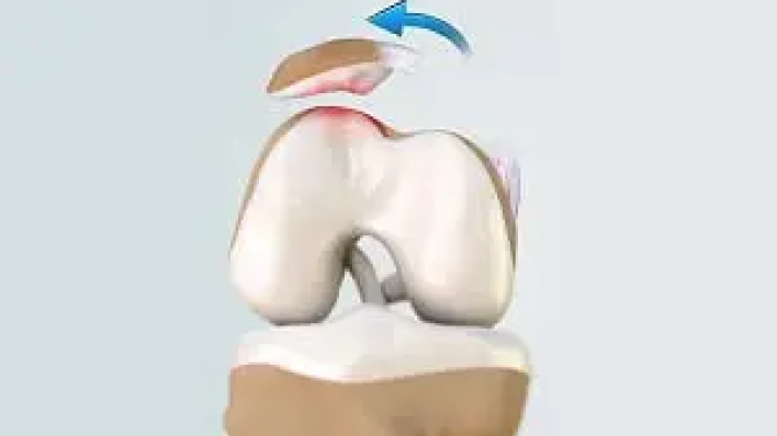 patellofemoral instability