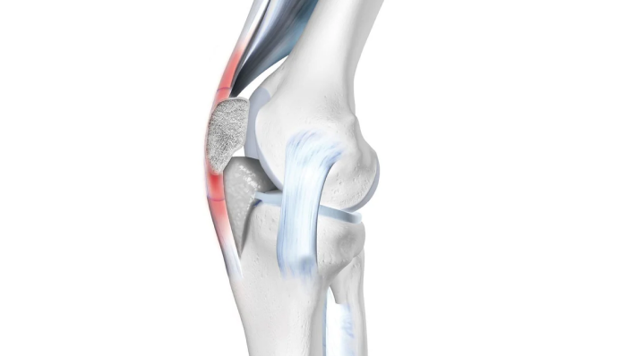 patellar tendinitis