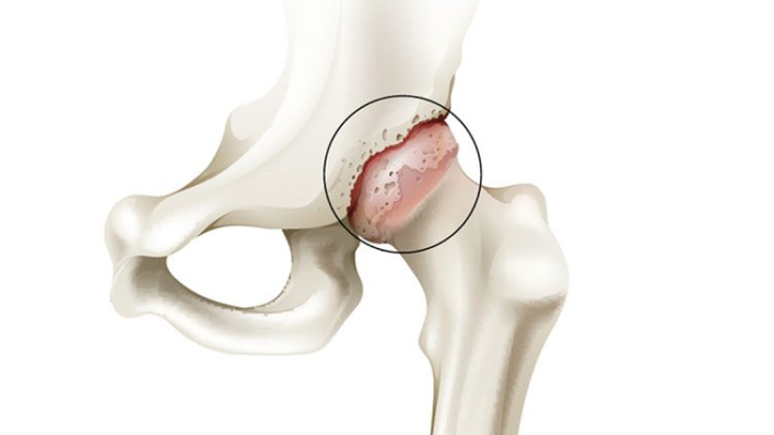 hip osteoarthritis