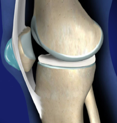 Prepatellar Bursitis: