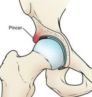 Cam Impingement