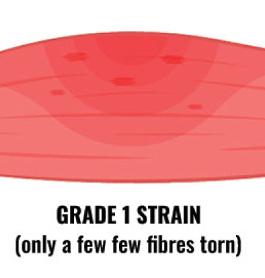 A mild hamstring strain, grade 1