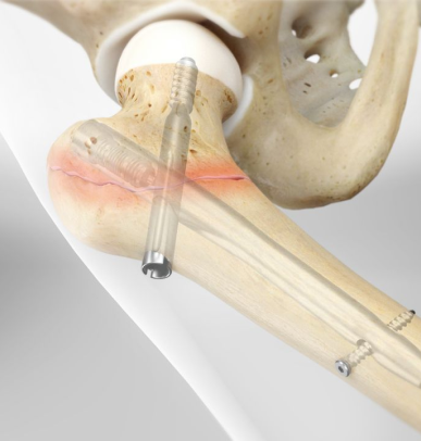 Femoral Neck Fractures
