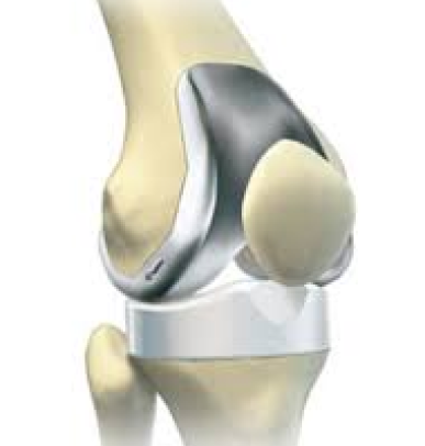 total knee replacement