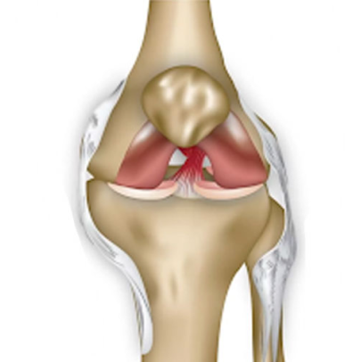sprain acl