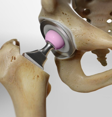 Total Hip Replacement