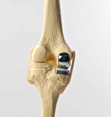 Partial Knee Implants