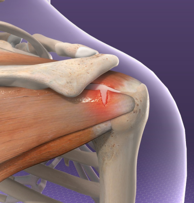 Rotator Cuff Tendinitis