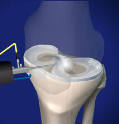 Arthroscopy for meniscus repair or removal