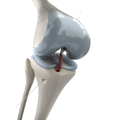 Anterior Cruciate Ligament (ACL) Tear