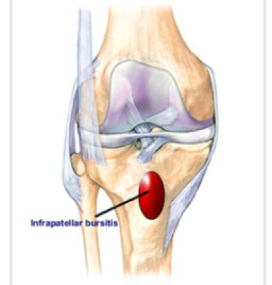Suprapatellar Tendinitis