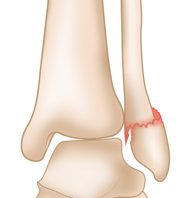 Stable (Nondisplaced) Fracture