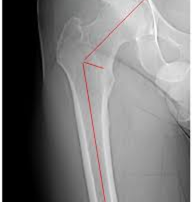 Primary Osteoarthritis