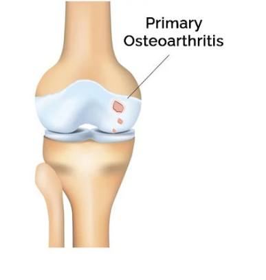 Primary Osteoarthritis