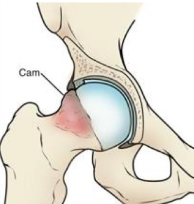 Pincer Impingement