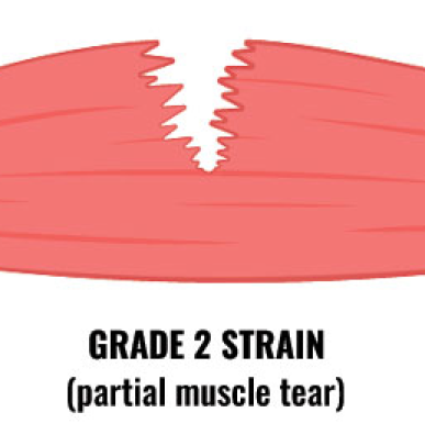 Partial hamstring tear or grade 2