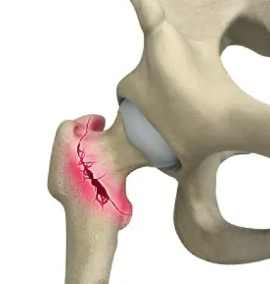 Intertrochanteric Fractures
