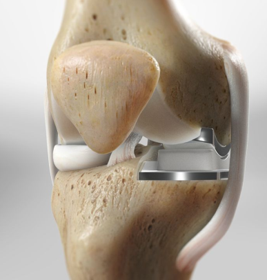 partial knee replacement