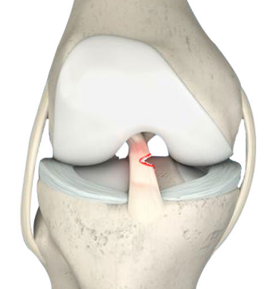 partial acl tear