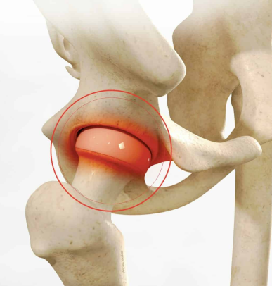 Hip Arthoscopy Dubai