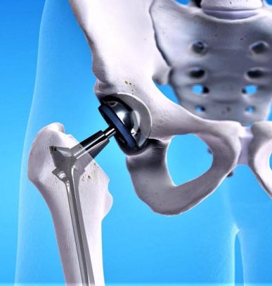 Robotic Hip Replacement Dubai