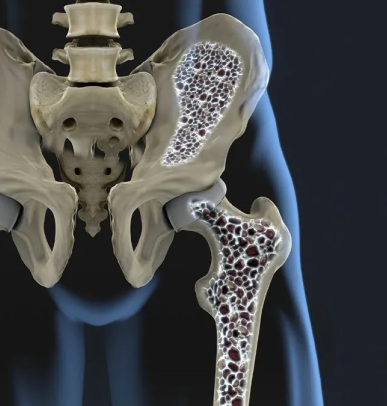 Primary Osteoporosis