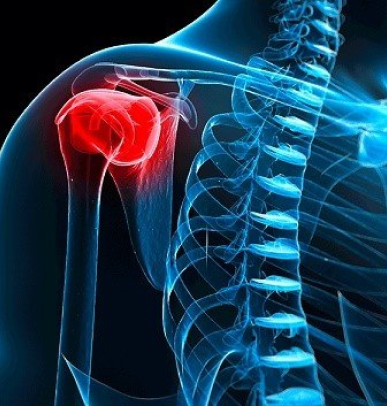 Shoulder Bursitis