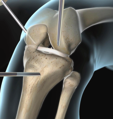 Ligament reconstruction for ACL or MCL tears