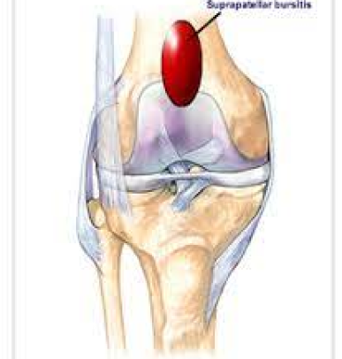 Infrapatellar Tendinitis
