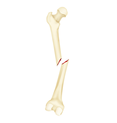 Displaced Fracture