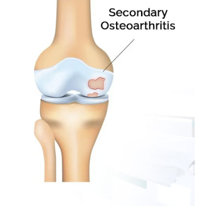 Secondary Osteoarthritis