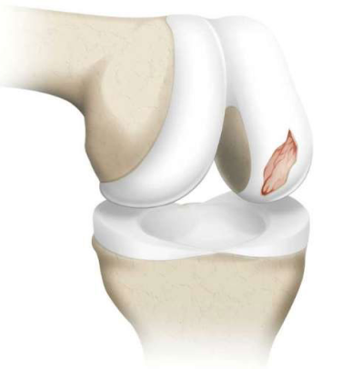 Chondral Injuries