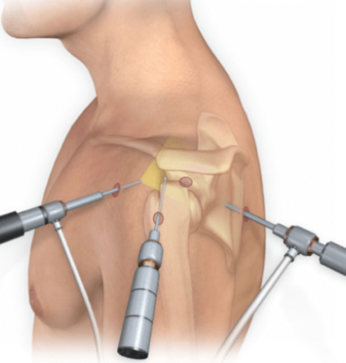 shoulder surgery Dubai