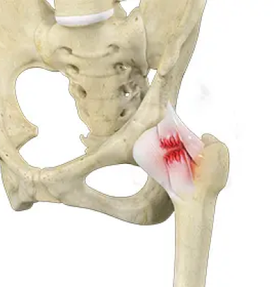 Hip Ligament Tears