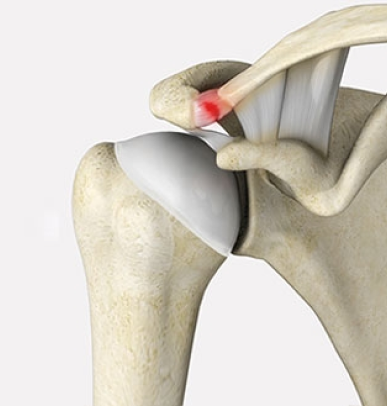 Acromion Deformity