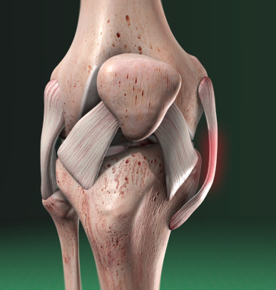 Medial and Lateral Collateral Ligament (MCL and LCL) Injuries