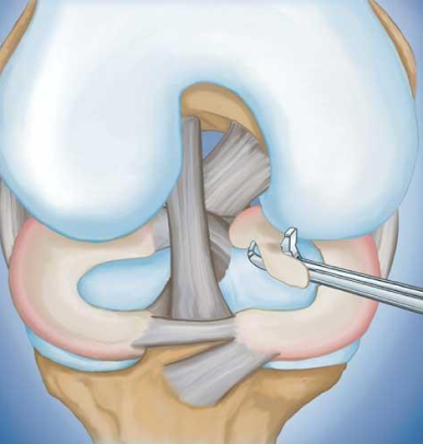 meniscal tears