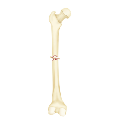 Comminuted Fracture