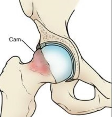 Combined Impingement