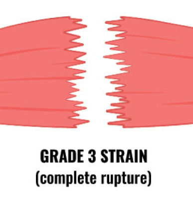 Severe hamstring tear or grade 3