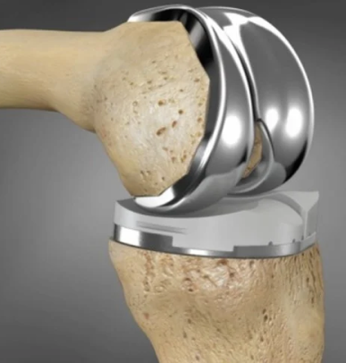 3D printed knee replacement in Dubai