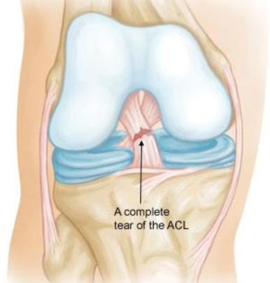 complete acl tear